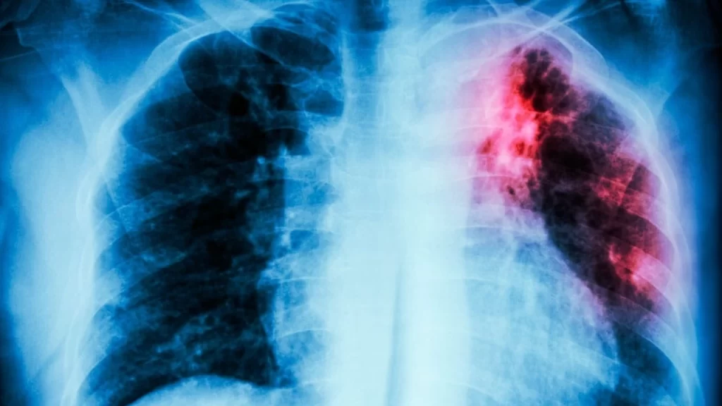 Con 967 casos reportados de Tuberculosis en Antioquia se encienden las alertas: ¿Cómo combatirla? Con 967 casos reportados de Tuberculosis en Antioquia se encienden las alertas: ¿Cómo combatirla?