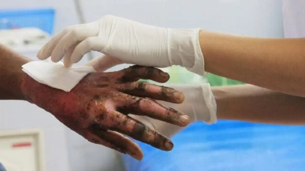 147 lesionados, 43 menores y 14 amputados: el crudo balance por pólvora en Antioquia